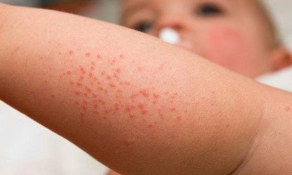 Dermatite atópica: o que é, causas, sintomas e pomadas