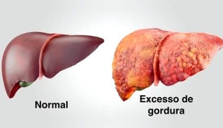 o que é gordura no fígado
